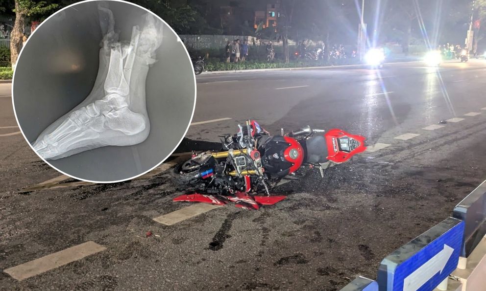 Kỳ tích 6 tiếng nối lại chân cho cô gái 19 tuổi sau tai nạn kinh hoàng với xe phân khối lớn ở Hà Nội