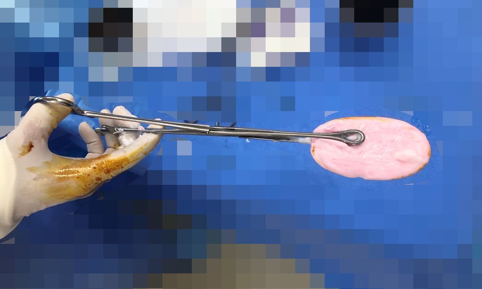 Bé gái 12 tuổi ở TP.HCM phải đi cấp cứu vì nhét xà phòng vào vùng kín lúc đang tắm