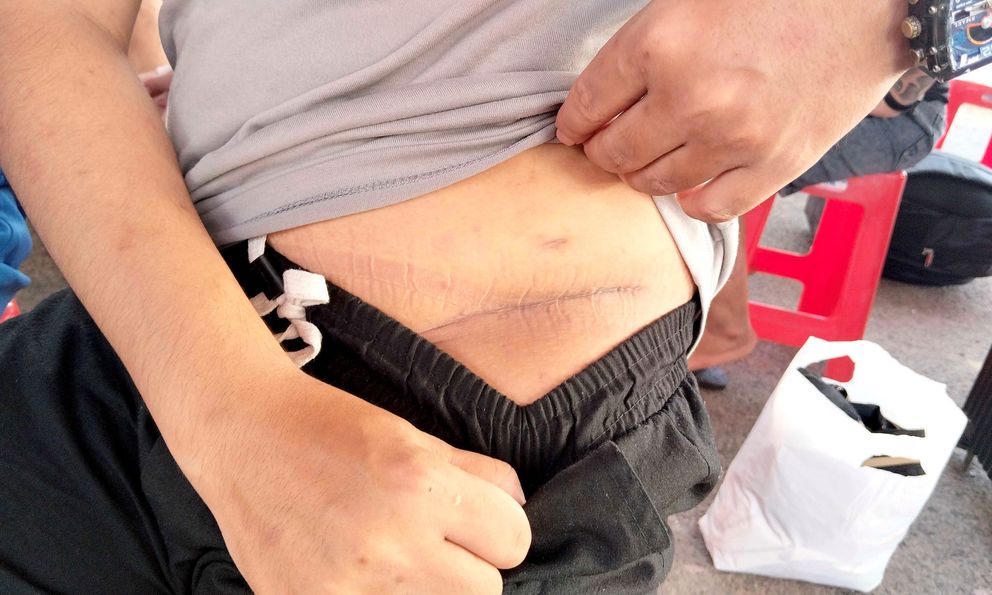 Nam thanh niên sang Campuchia làm “việc nhẹ lương cao” bị cưỡng ép cắt bỏ một quả thận: Vết sẹo dài bên mạn sườn gây ám ảnh