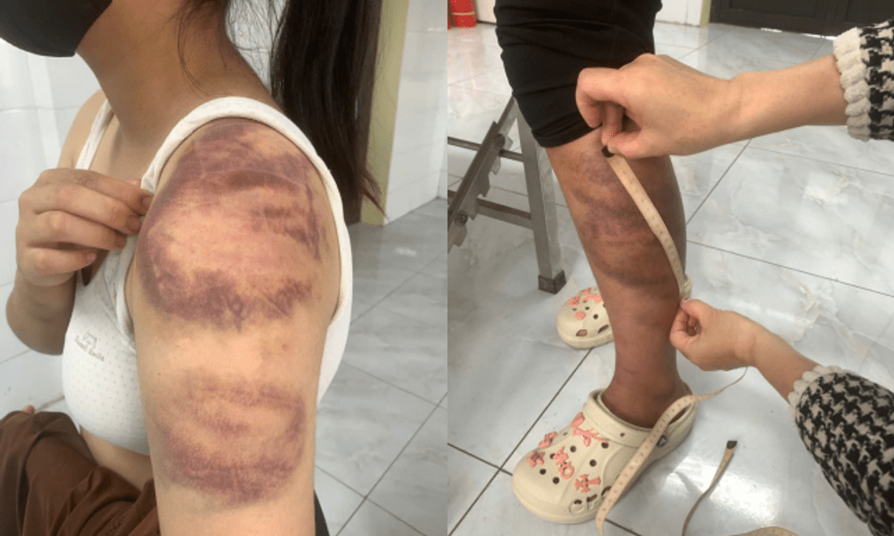 Phẫn nộ ở Bắc Ninh: Gã đàn ông 32 tuổi trói con gái 13 tuổi đánh bầm tím khắp người, vợ mang thai cũng không tha