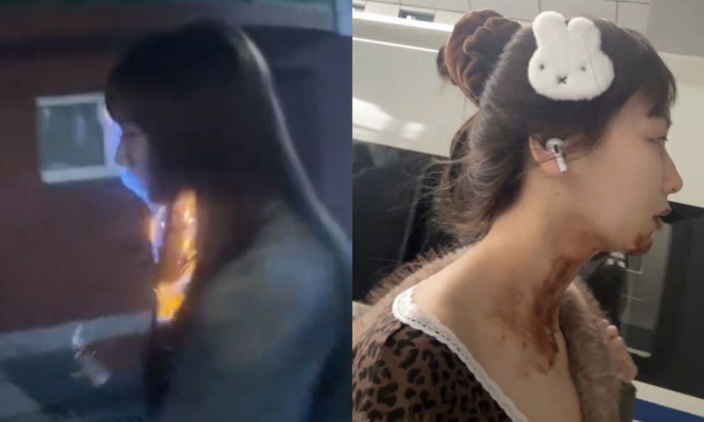 Nữ diễn viên bị bỏng nặng gương mặt ngay trong ngày sinh nhật tuổi 27 vì đu trend 