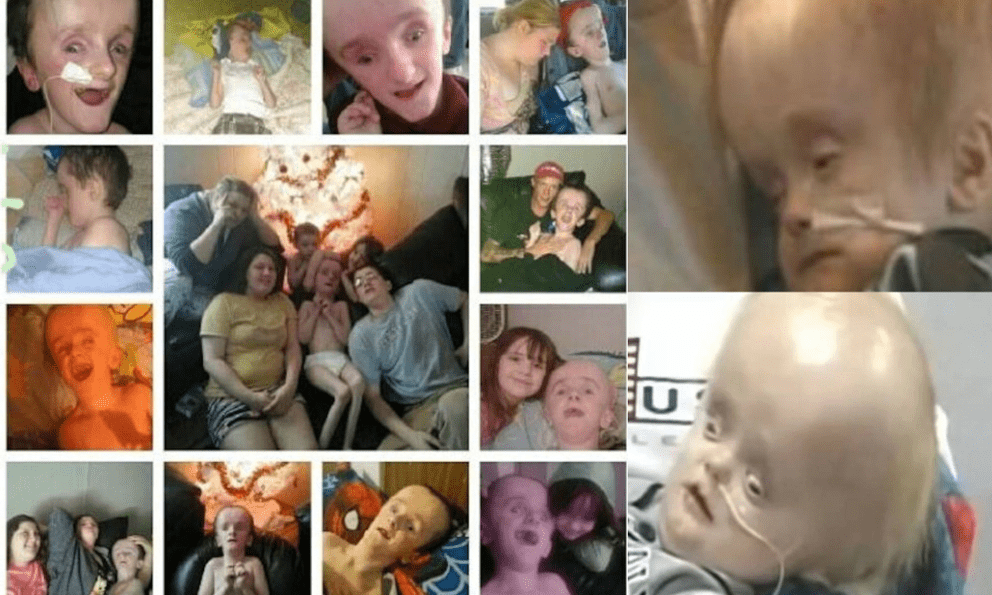 Cậu bé sinh ra không có não sống 12 năm cuộc đời thế nào?