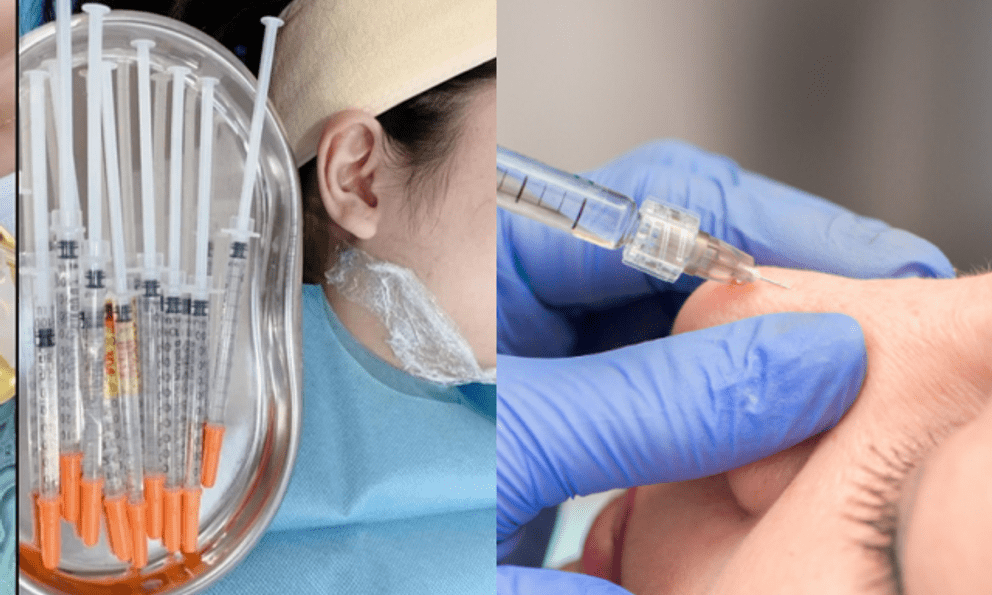 Cô gái ở TP.HCM gặp biến chứng sau mũi tiêm 27 triệu tại nhà, người thực hiện 