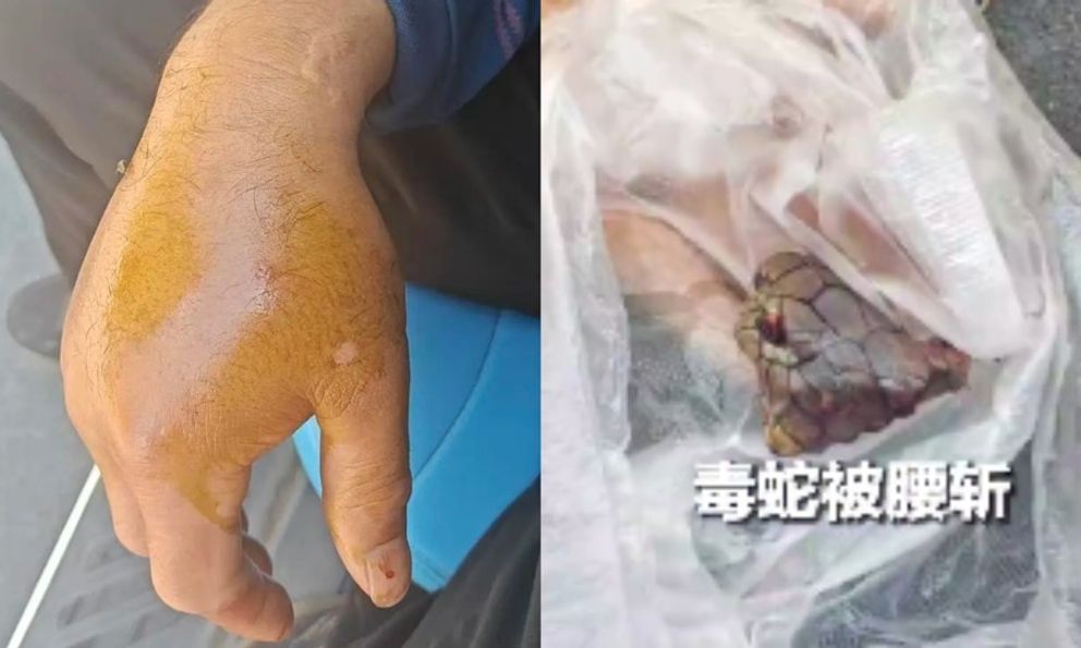 Bị rắn hổ mang chúa dài 2 mét cắn, người đàn ông chém đứt xác rắn rồi đến bệnh viện