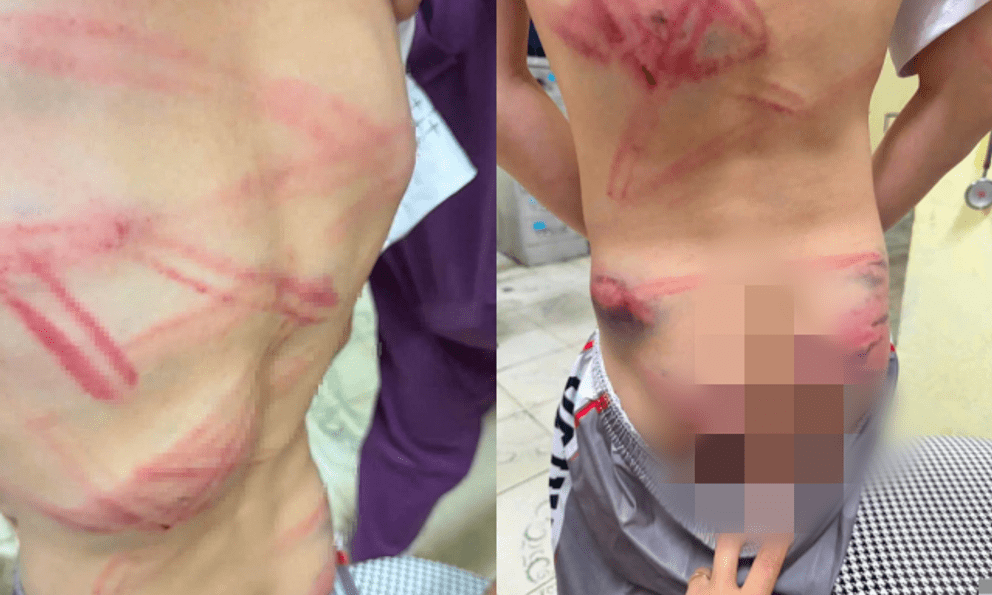 Bé trai 9 tuổi nhập viện với nhiều vết bầm tím: Lời khai của người cha sau khi thừa nhận đánh con gây phẫn nộ
