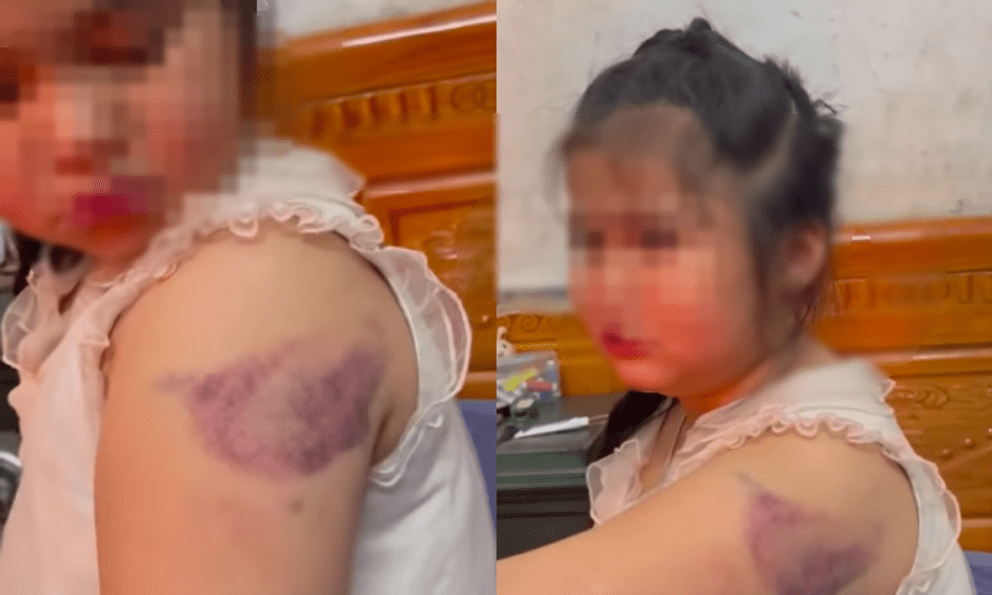 Clip 32 giây vụ học sinh lớp 1 nghi bị cô giáo đánh bầm tím tay vì viết chữ xấu
