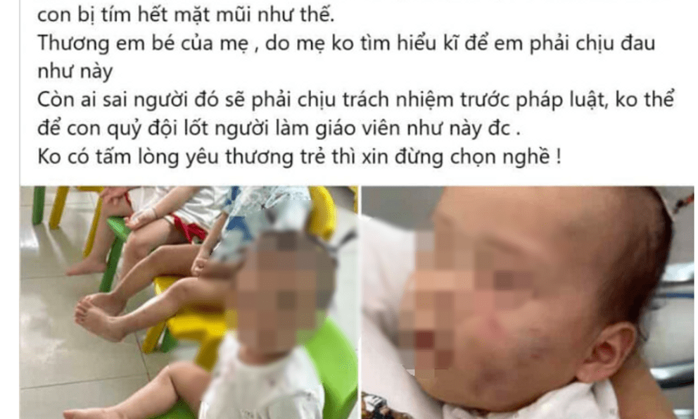 Bé gái bị bầm tím mặt sau khoảng 7 tiếng ở nhà trẻ tư thục: Tình trạng sức khoẻ hiện tại 