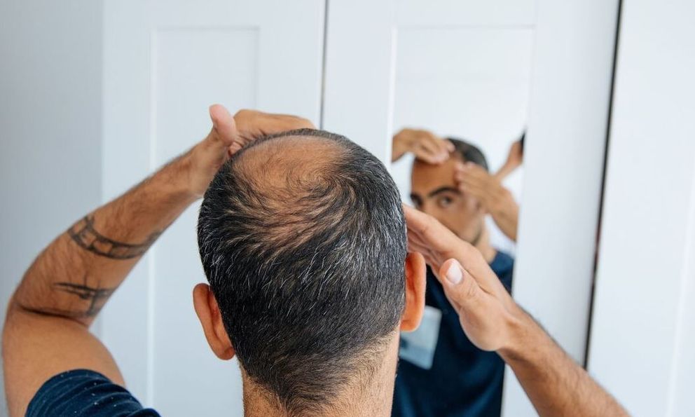 Loại đồ uống nam giới nên tránh xa kẻo tóc “rụng sạch”, hói đầu lúc nào không hay