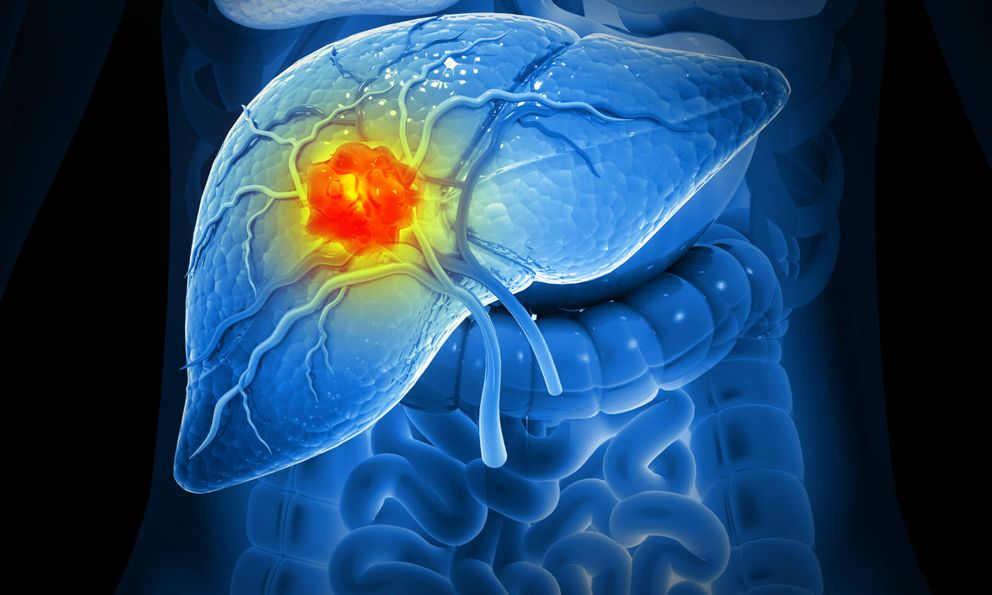 3 dấu hiệu sớm của ung thư gan nhưng dễ bị bỏ qua nhất