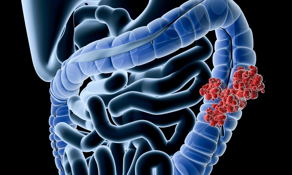 Muốn ngăn chặn ung thư đại tràng, đây là việc cần làm đầu tiên