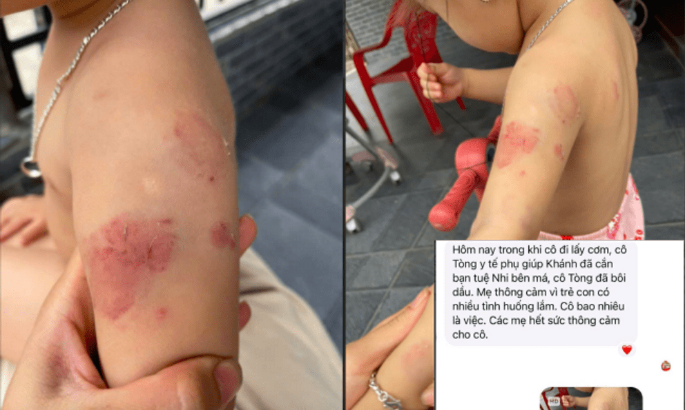 Bé hơn 2 tuổi có nhiều vết cắn, bầm tím: Giáo viên nói 