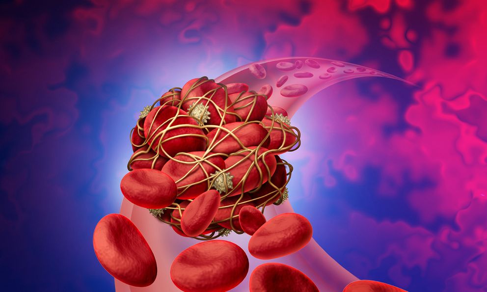 Cục máu đông rất 