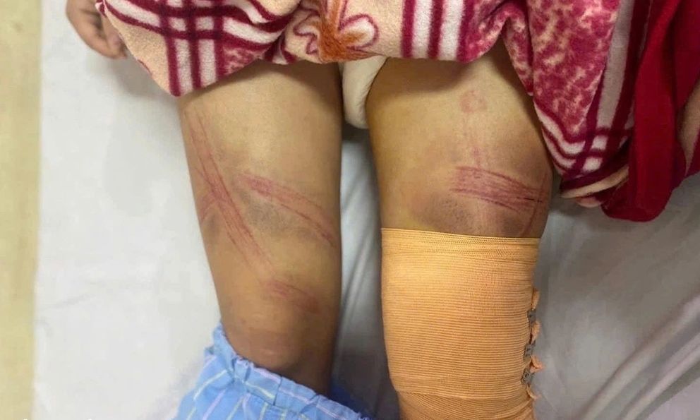 Vụ bé gái lớp 7 bị bố đánh nhập viện ở Nghệ An: Nguồn cơn từ con lợn đất?