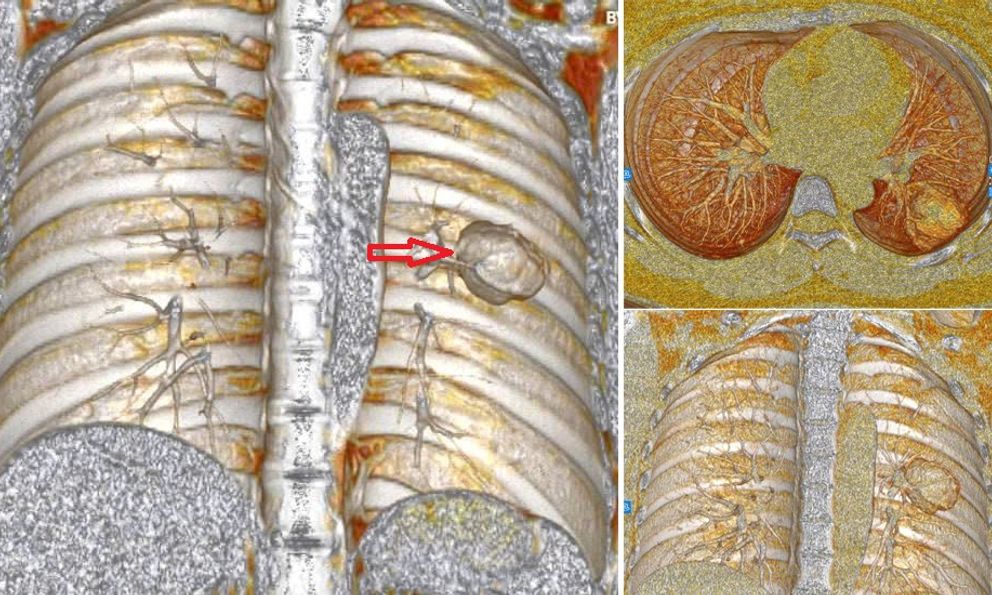 Xét nghiệm có chỉ số mang thai, cô gái ngỡ ngàng khi “thủ phạm” là ung thư tạo triệu chứng đánh lừa