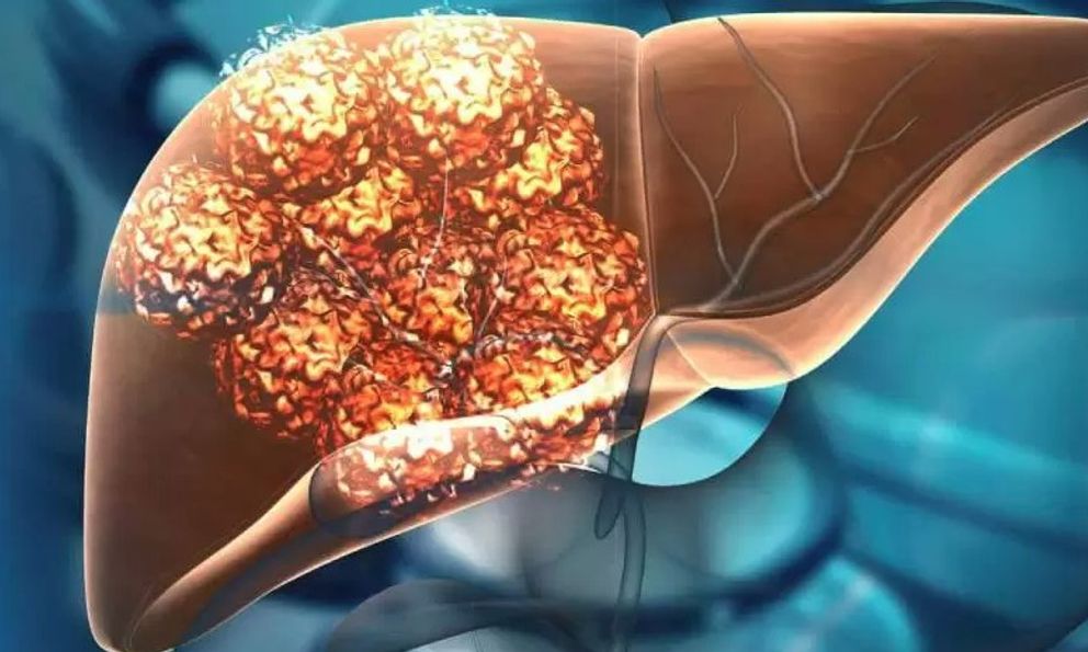 Khối u gan 6 cm đột nhiên biến mất sau khi chuyện này xảy ra