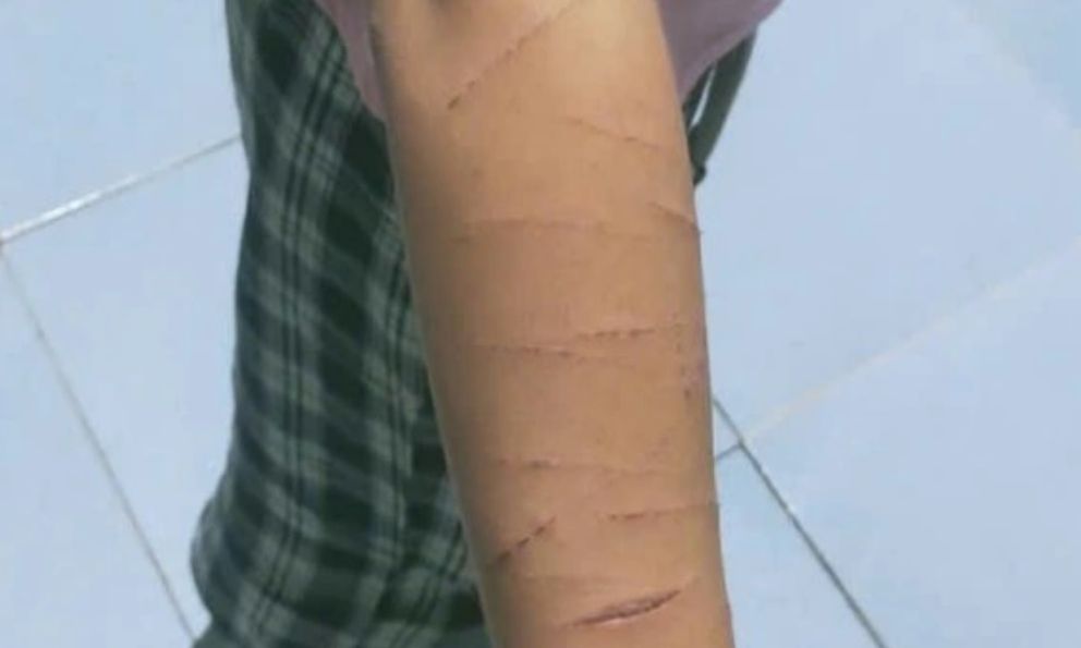 Bé gái đến trường với nhiều vết thương trên người, giáo viên liền báo công an: Bất ngờ người gây chuyện