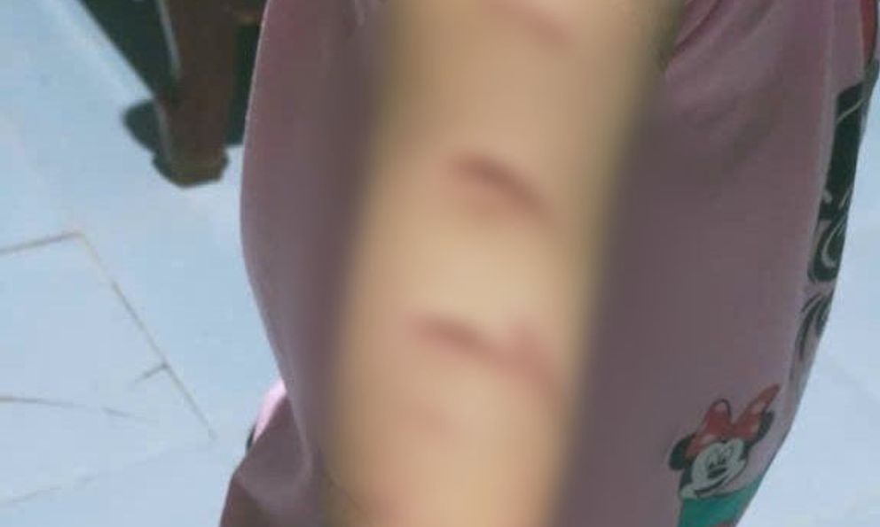 Vụ bé gái bị chị họ 12 tuổi dùng dao rạch khắp người: Mâu thuẫn từ việc em giật áo chị rủ chơi cùng