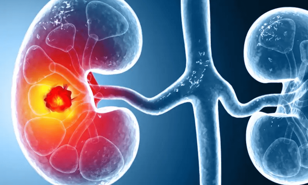 Số ca mắc ung thư thận gia tăng trên toàn cầu: Ở giai đoạn sớm hay muộn đều có 3 dấu hiệu này