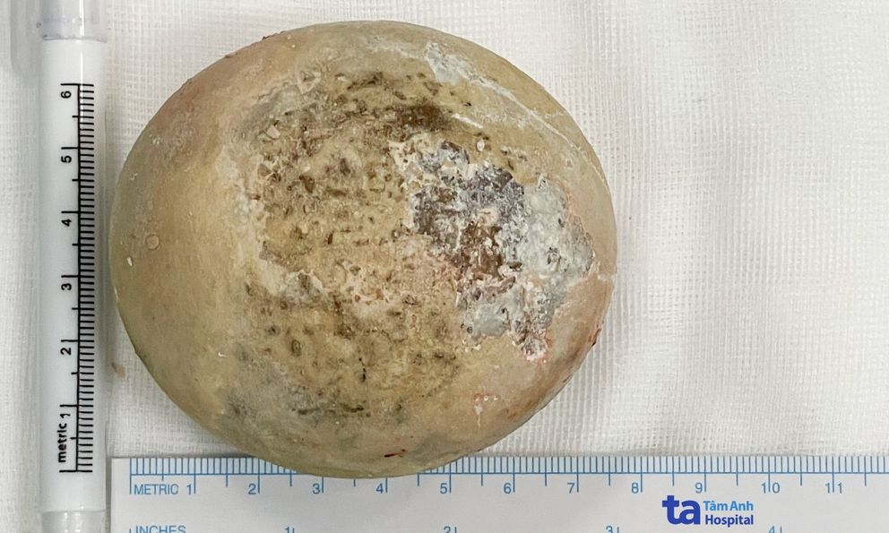 Người đàn ông có sỏi to bằng nắm tay: Mổ xong phát hiện thêm điều khủng khiếp