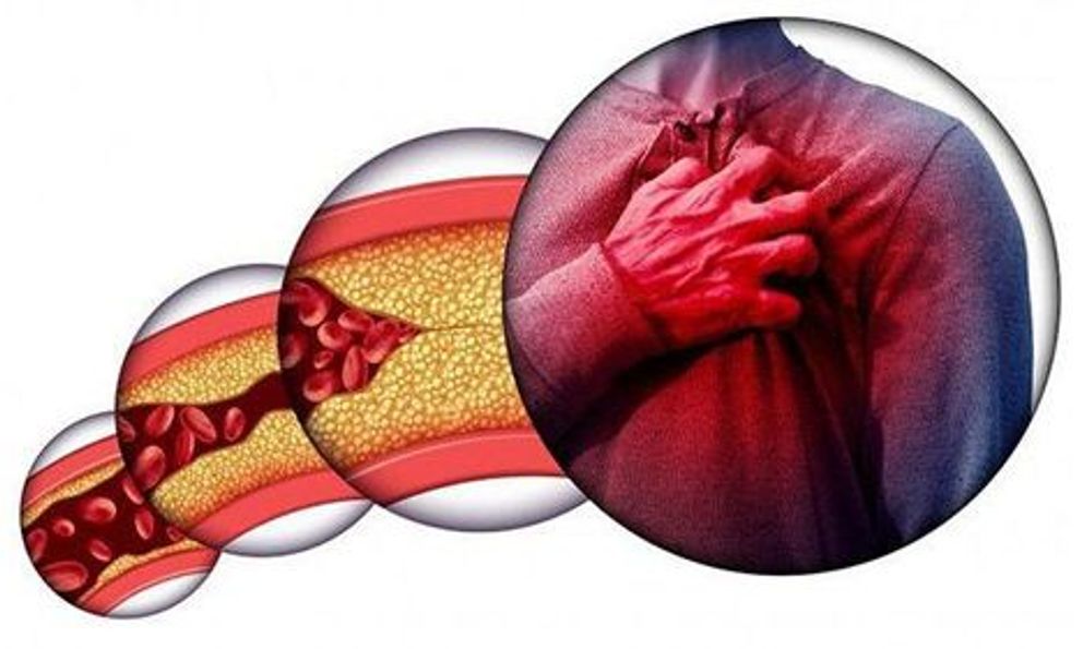 Gầy nhưng mỡ máu vẫn cao vút: Không hề vô lý, 