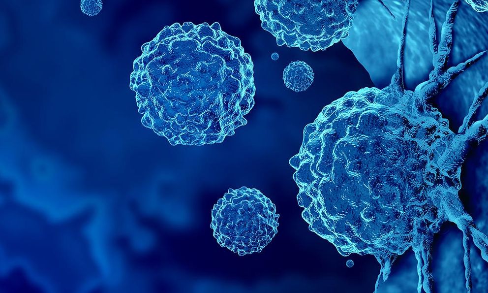 Loại ung thư đứng thứ 2 về tỉ lệ tử vong tại Việt Nam: 5 dấu hiệu sớm nhất ai cũng nên biết