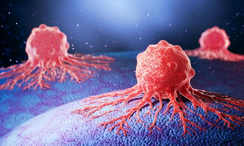 Chỉ có 1 dấu hiệu, đi khám phát hiện mắc cùng lúc 2 bệnh ung thư: Cảnh báo từ bác sĩ ung bướu