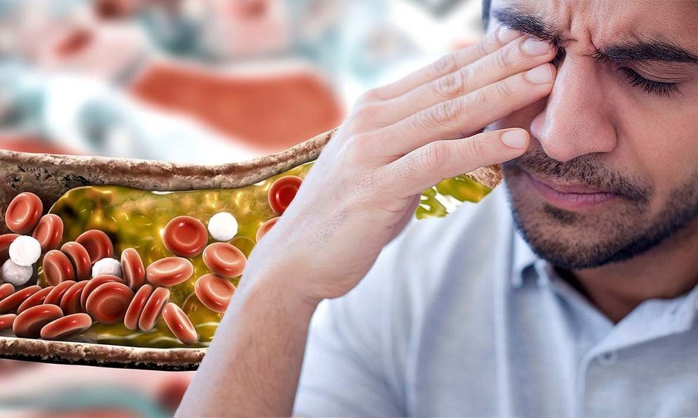 Nhìn vào mặt cũng có thể biết mỡ máu cao hay không: Nếu thấy 2 dấu hiệu này, hãy đi khám ngay