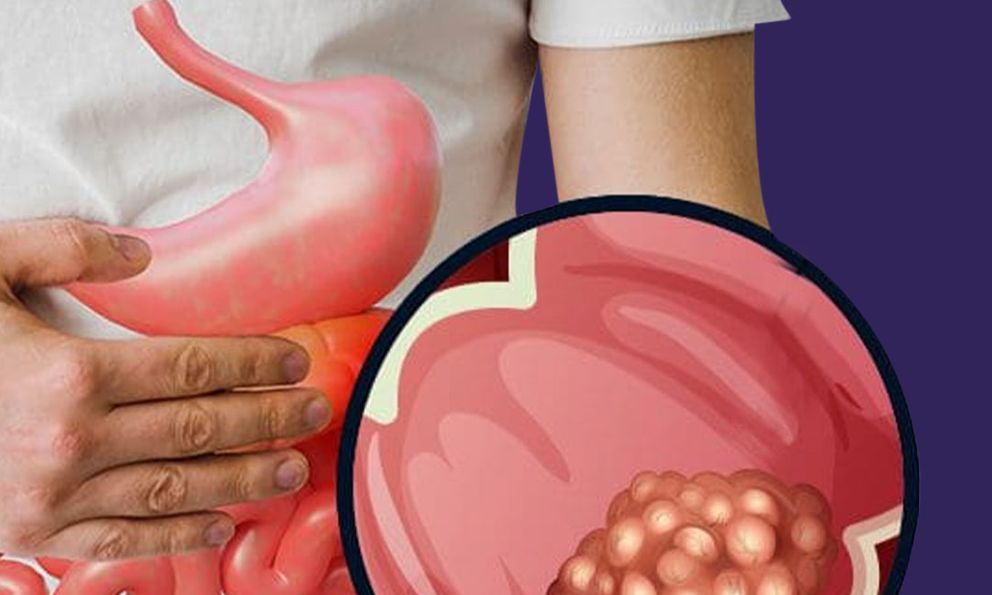 Phát hiện ung thư giai đoạn 4 ở tuổi 26, nam thanh niên hối hận: Giá như tôi không bỏ qua triệu chứng này