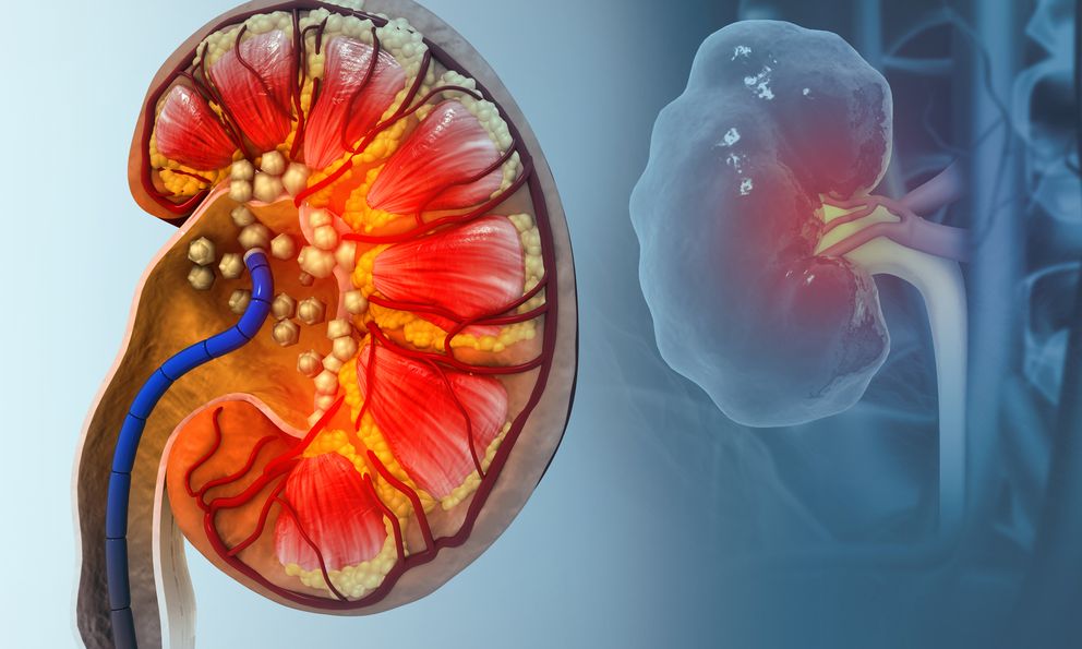 Thận chi chít sỏi chỉ vì uống 1 thứ để 