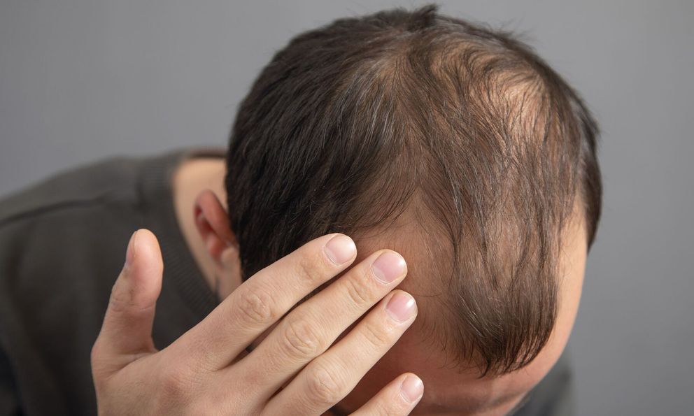 Thường xuyên ăn 5 món này, đừng trách vì sao tóc rụng lả tả