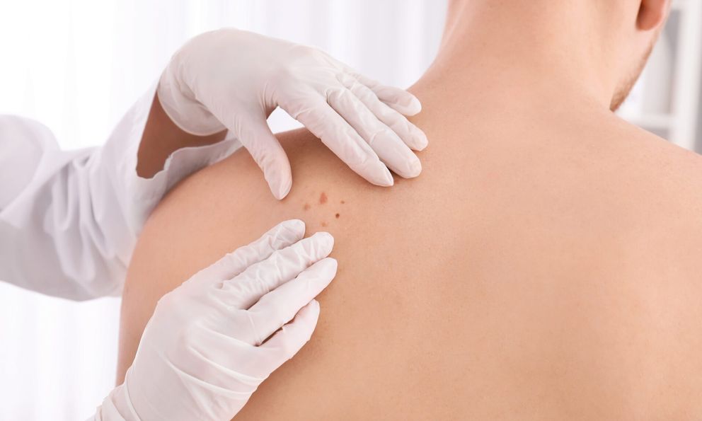 Đây là dấu hiệu sớm nhất của ung thư da nhưng rất hay bị bỏ qua
