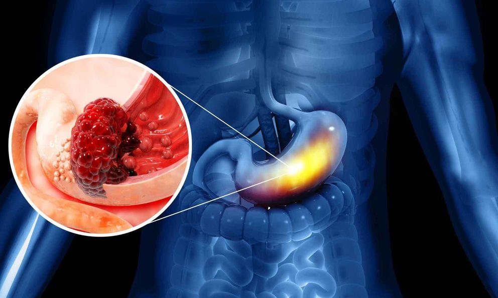 Không chỉ rượu bia, ung thư dạ dày thường 