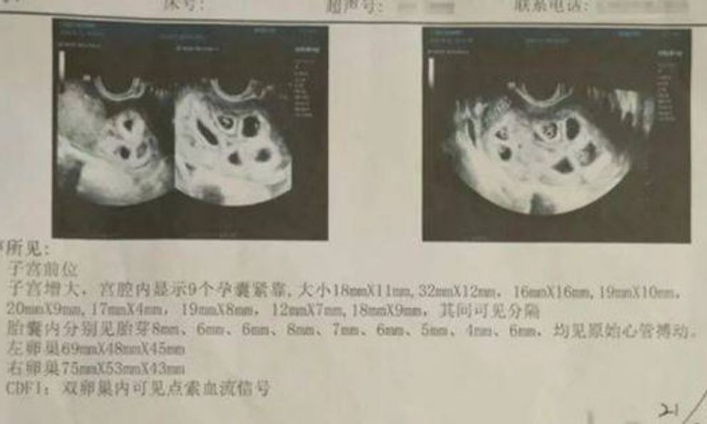 Sốc: Đang chữa trị hiếm muộn, người phụ nữ 25 tuổi phát hiện mang thai 9 con 