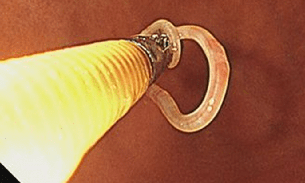 Người đàn ông đột nhiên đau bụng, nội soi bác sĩ nổi da gà phát hiện thứ dài 5cm 