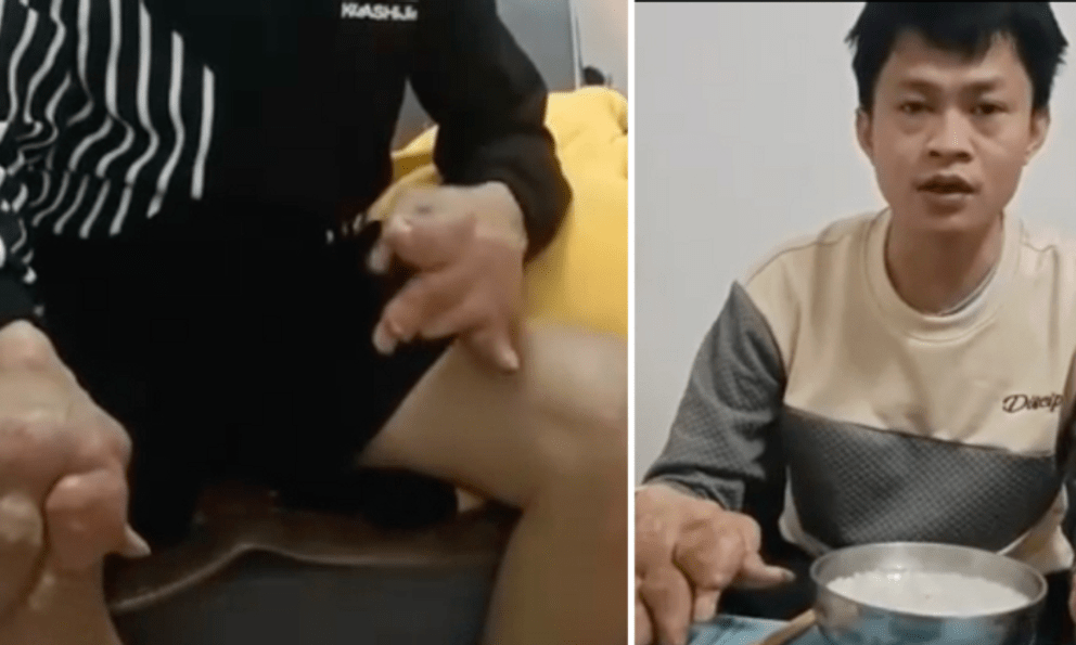 Chàng trai 30 tuổi bàn tay sưng phồng, co quắp như 