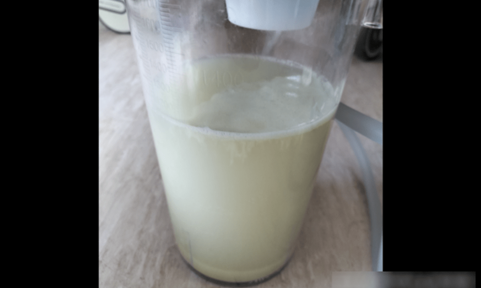 Hút ra 1000ml đờm từ phổi của người đàn ông, không hút 