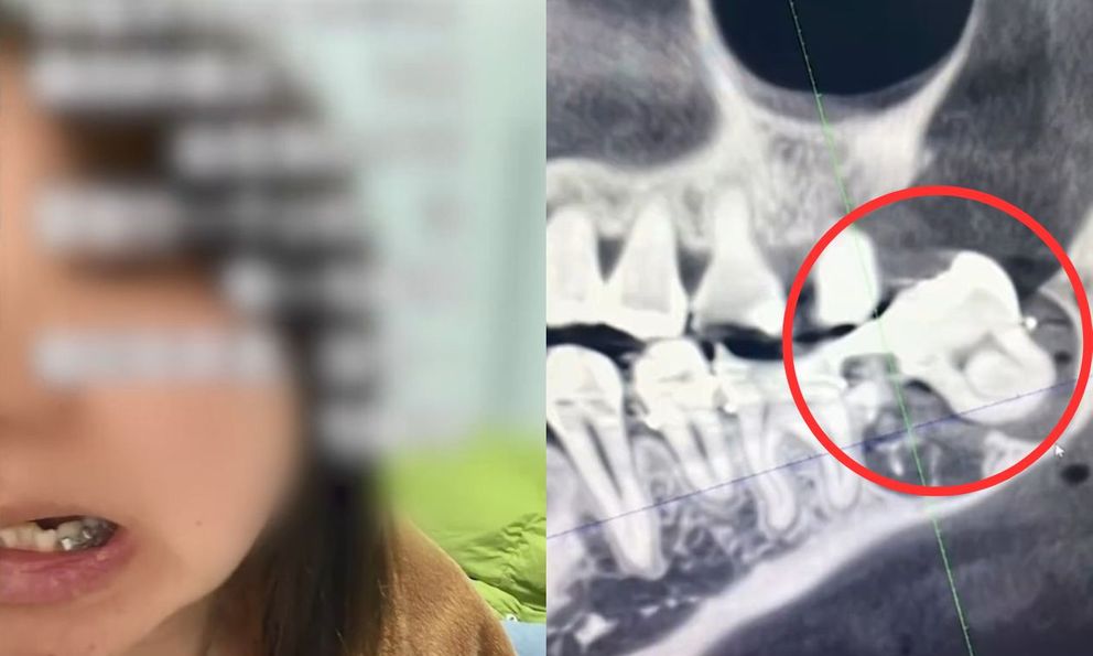 Đi nhổ răng khôn bị bác sĩ nhổ nhầm răng thật, người phụ nữ đã có lựa chọn tiêu cực