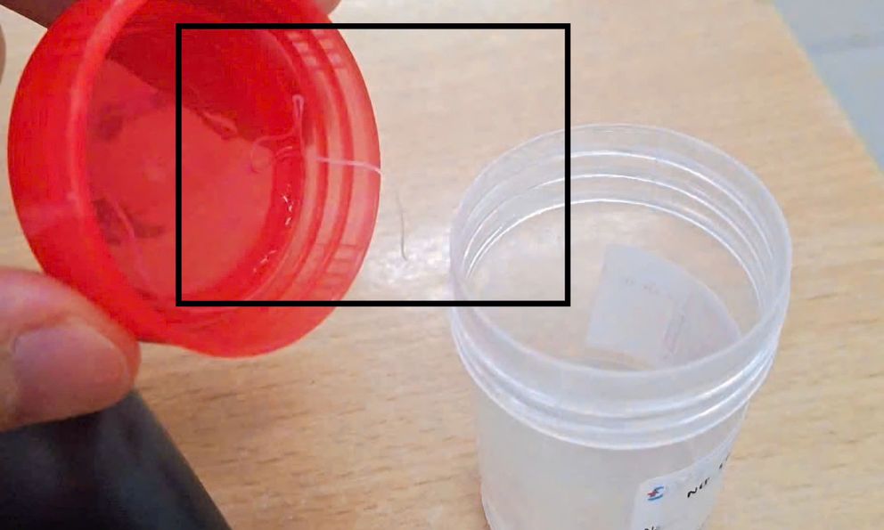 Bệnh viện Bệnh Nhiệt đới Trung ương tiếp nhận điều trị 1 trường hợp hiếm gặp