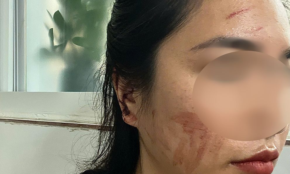 Kết quả giám định vụ cô gái cầu cứu sau khi bị bạn cùng phòng trọ hành hung rách tai vì lấy nhầm nồi nấu ăn