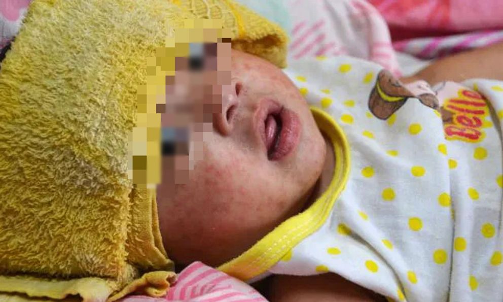 Điều gì xảy ra nếu trẻ chỉ tiêm 1 mũi vắc xin sởi mà không tiêm mũi 2?