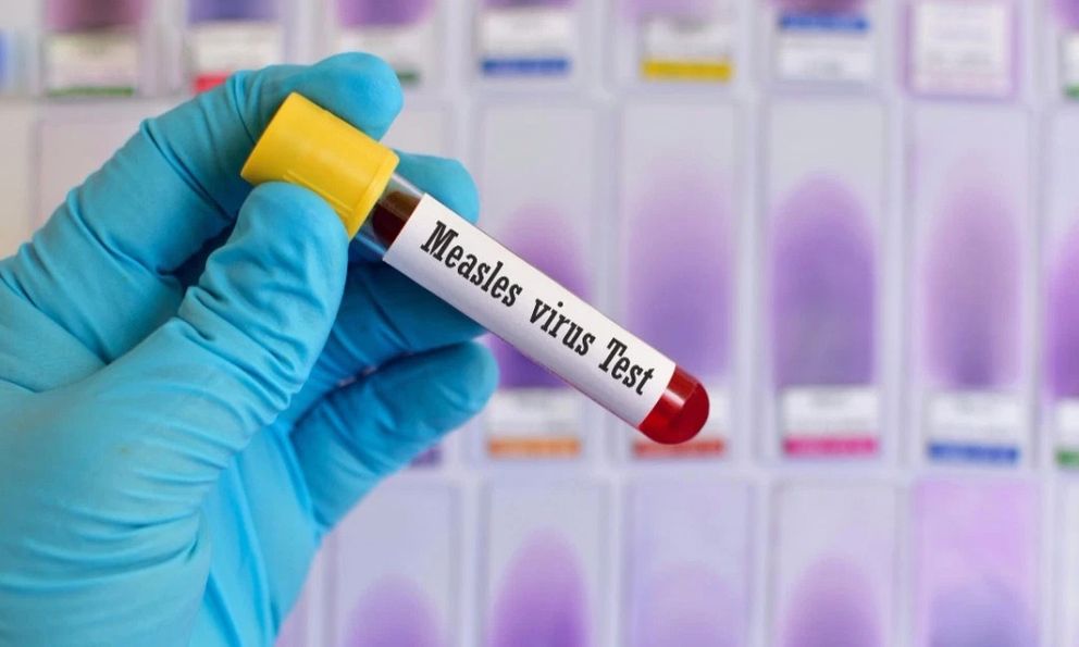 Xét nghiệm kháng thể sởi là gì, có phải lần nào tiêm vắc xin sởi đều cần làm không?