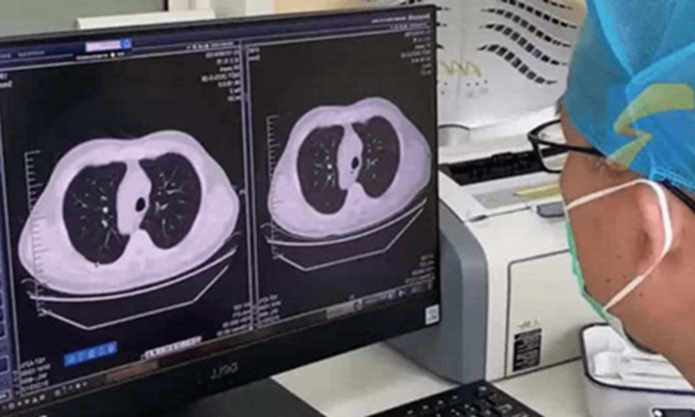 Cảm lạnh và ho, phổi trái của nam sinh đột nhiên 