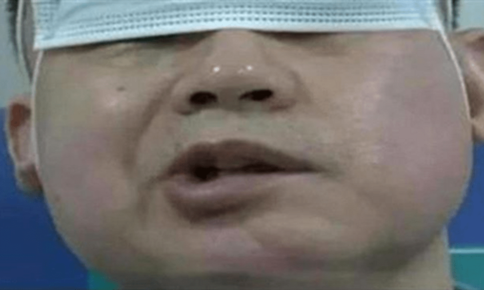 Bật điều hòa ngủ cho mát, người đàn ông bị liệt mặt, bác sĩ cảnh bảo thói quen yêu thích của người trẻ