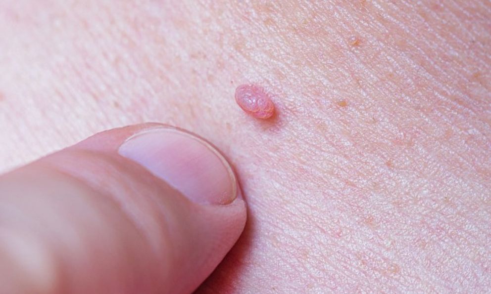 4 loại bệnh ngoài da do nhiễm HPV, tiêm vắc xin HPV liệu có phòng được hết?