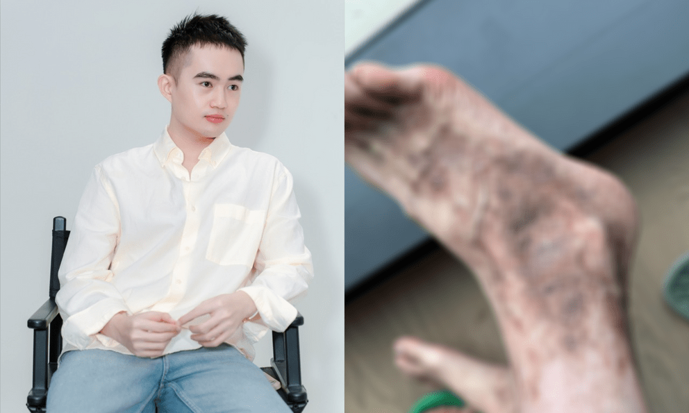 Tina Thảo Thi bị viêm mao mạch hoại tử: 