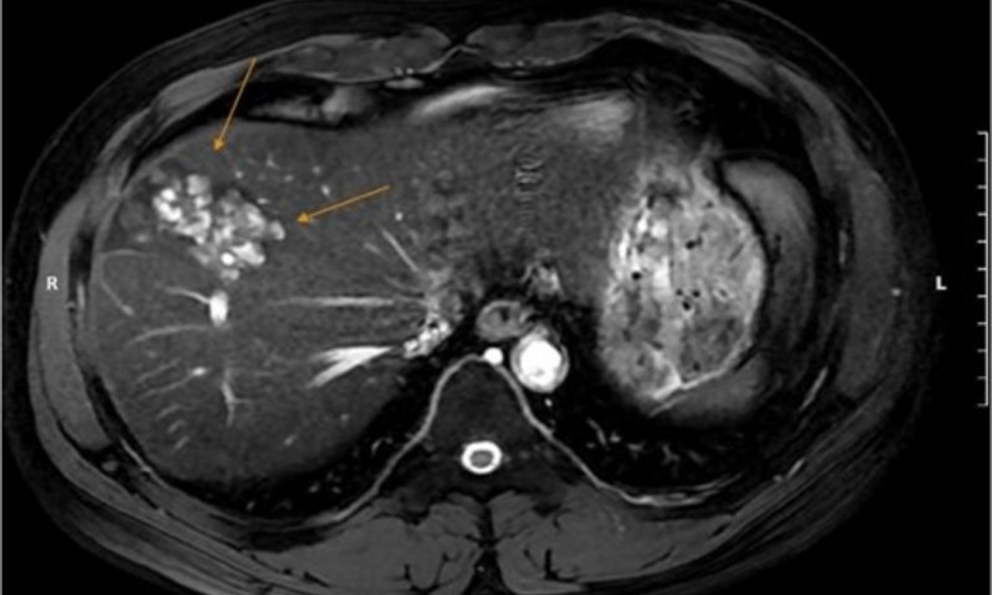 Người đàn ông 41 tuổi gan đầy ổ sán lá gan vì thói quen này của nhiều người Việt