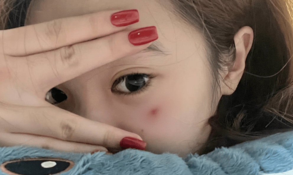 Một bất thường trên da đang cố TỐ CÁO ung thư máu nhưng lại bị đổ cho 