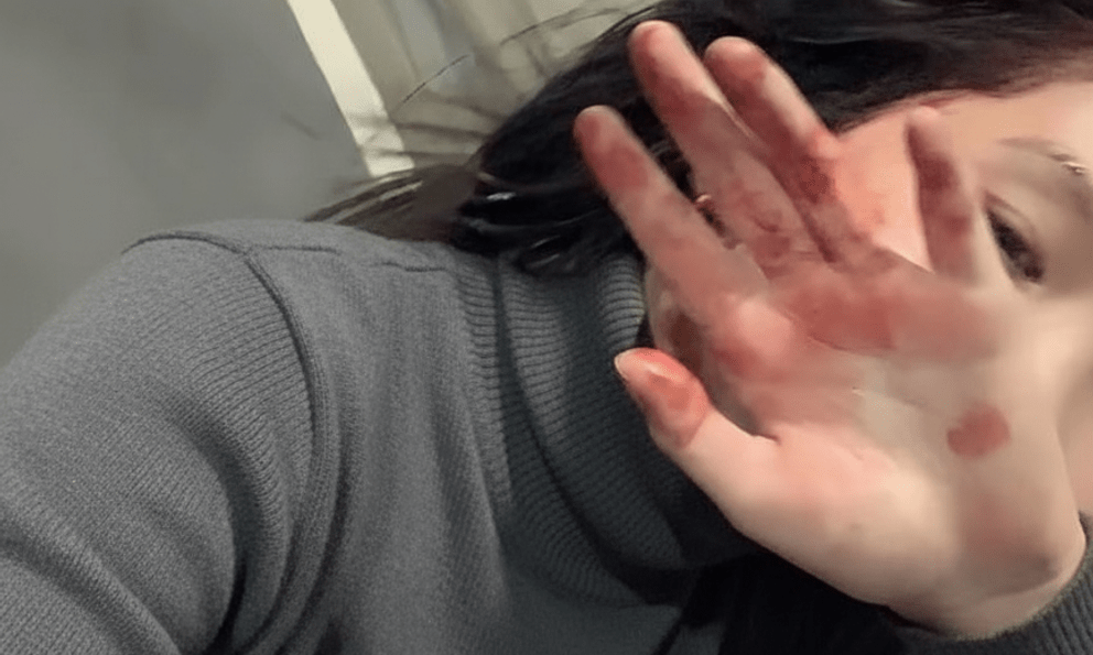 6 bất thường ở bàn tay đang ám chỉ lượng đường trong máu vượt ngưỡng an toàn, tiếc là rất ít người để ý!