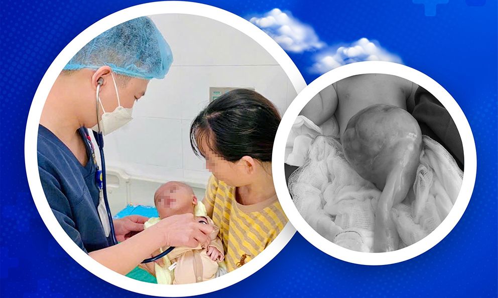 Hành trình 71 ngày giành lại sự sống cho trẻ sơ sinh mang khối thoát vị rốn 