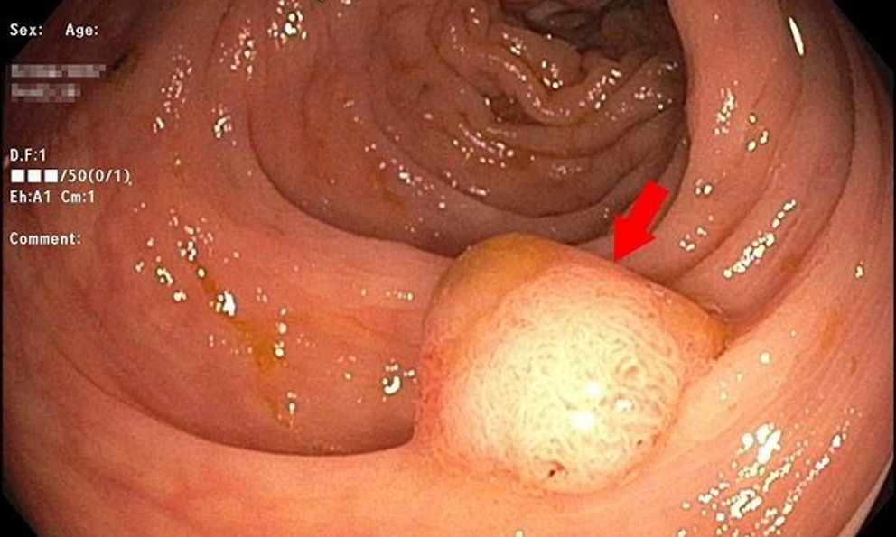 20 tuổi đã suýt bị ung thư đại tràng: Bác sĩ nói người trẻ có 4 dấu hiệu này khi đi vệ sinh phải đi khám gấp